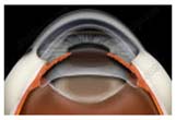 IOL Intraocular Lens Implant Treatment Cost India , Eye Surgery Lens Implants, IOL Intraocular Lens Implants